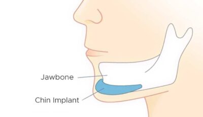 تجميل الذقن