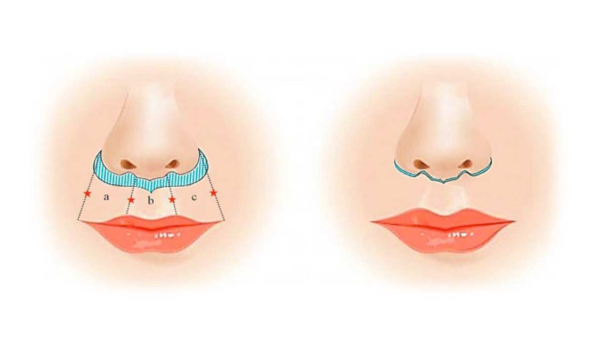 lip-lift