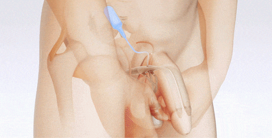 Penile prothesis