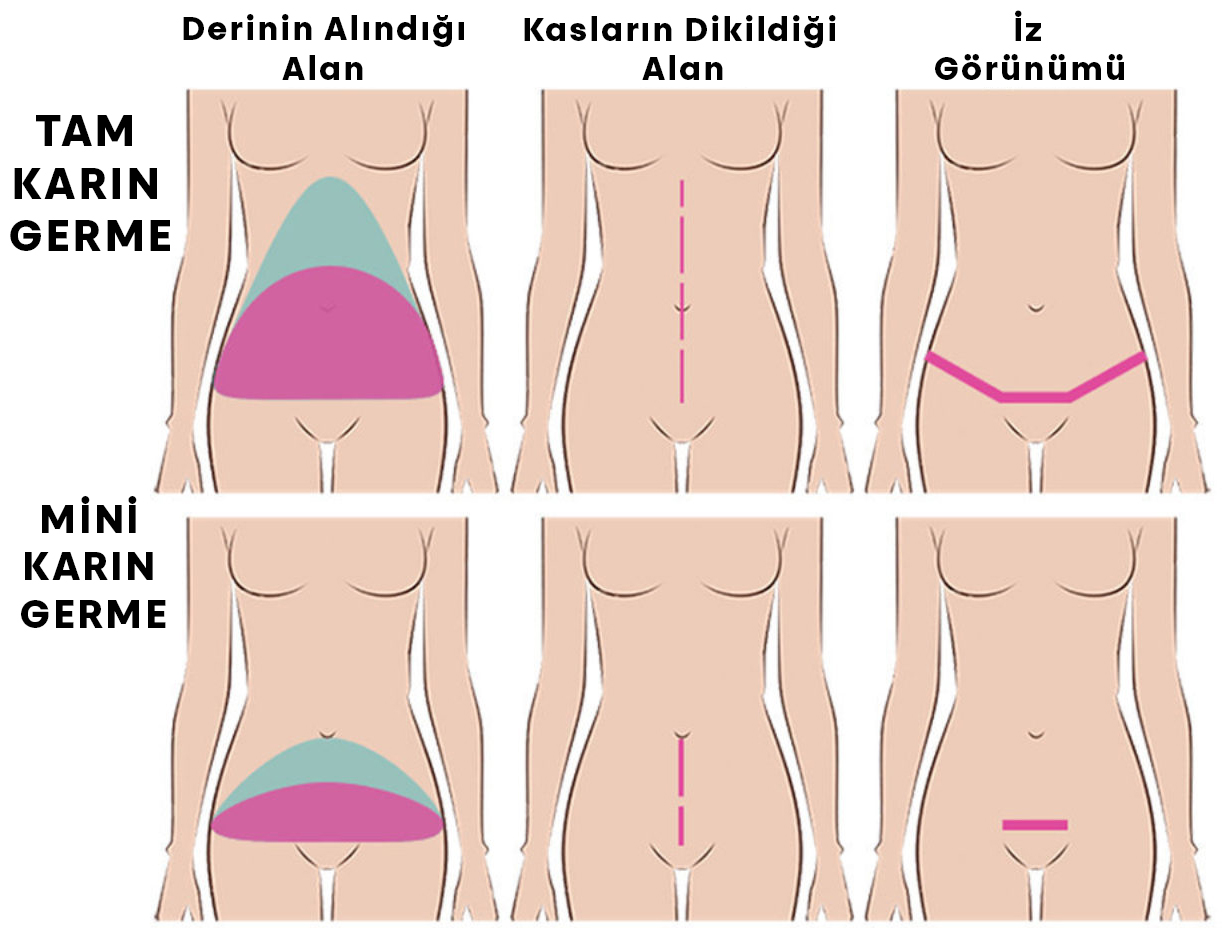 tam-mını karın germe