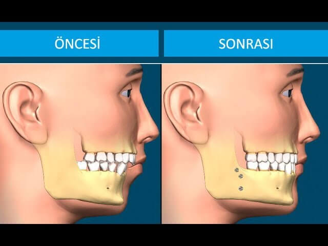 cene cerrahisi