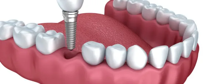 diş implantı