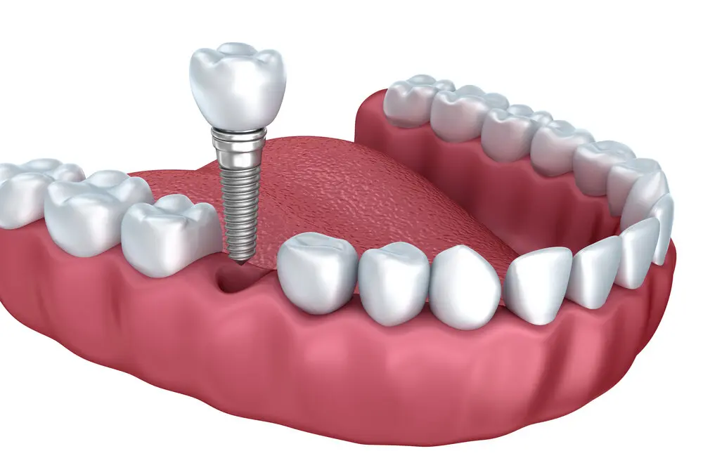 diş implantı