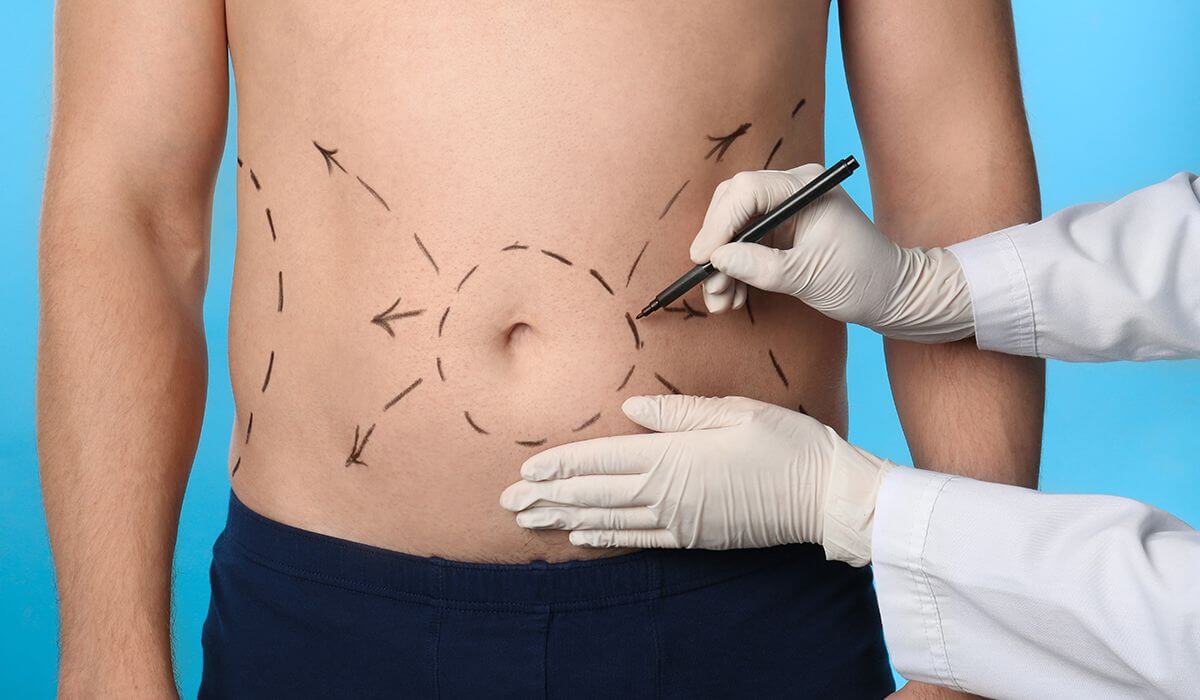 erkek vaser liposuction